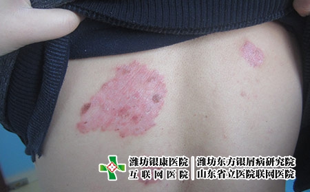 濰坊牛皮癬的癥狀表現有哪些？牛皮癬是什么樣的