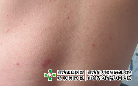 濰坊牛皮癬有哪些的危害，牛皮癬影響大嗎