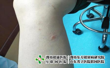 濰坊哪種藥物治療牛皮癬，牛皮癬怎么治