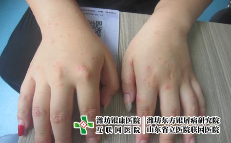 濰坊牛皮癬常見誤區(qū)，牛皮癬有哪些認識上的誤區(qū)