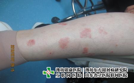 濰坊看牛皮癬去哪家醫院，濰坊東方怎么樣