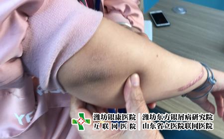 濰坊牛皮癬平時要注意什么，牛皮癬患者注意事項