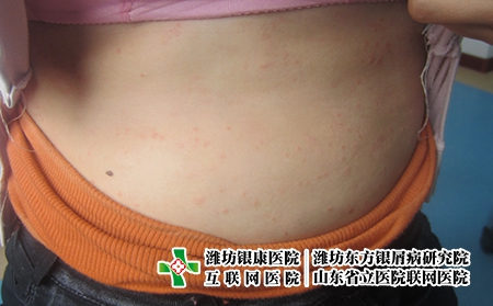 濰坊血熱型牛皮癬的特征，血熱牛皮癬什么樣