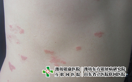 有益牛皮癬康復水果是什么，濰坊牛皮癬怎么食療