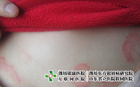 濰坊青少年為什么會患上牛皮癬，得牛皮癬是什么原因