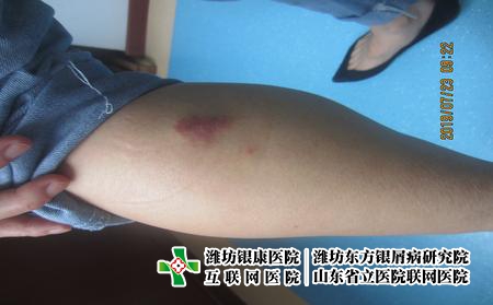 濰坊治療牛皮癬哪個醫院好?濰坊哪里能治好牛皮癬?