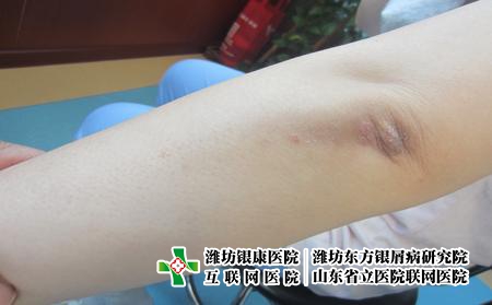 濰坊牛皮癬患者春天保養注意什么？牛皮癬春季要怎么辦