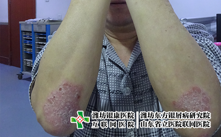 濰坊治療牛皮癬大概要花多少費用，治牛皮癬多少錢