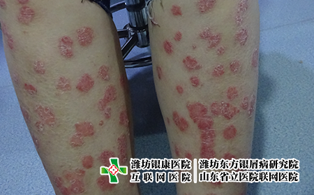 濰坊治療牛皮癬一般需要的費(fèi)用?牛皮癬可以用醫(yī)保報銷嗎?