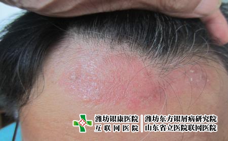 濰坊面部牛皮癬如何處理，臉上的牛皮癬怎么治