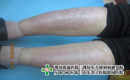 濰坊治療牛皮癬大概要多少錢嗎，治療牛皮癬貴嗎