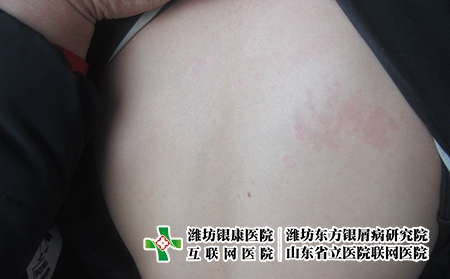 濰坊牛皮癬是怎么被引起，牛皮癬老反復怎么回事