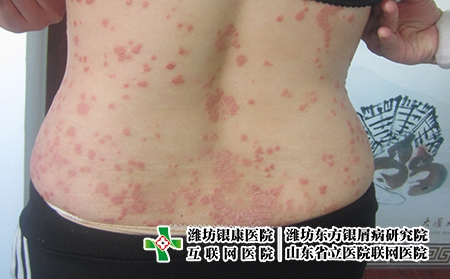 濰坊牛皮癬怎么日常保護(hù)？得了牛皮癬生活方式