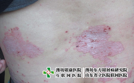 濰坊牛皮癬治療需要知道的常識，牛皮癬治療要知道什么