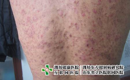 濰坊哪里能看牛皮癬，濰坊牛皮癬醫院好嗎