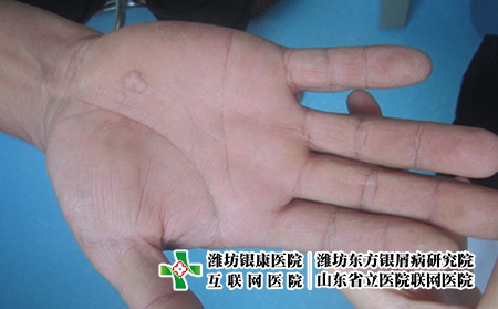 手部牛皮癬癥狀圖片