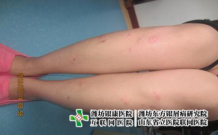 濰坊牛皮癬是怎么遺傳的，牛皮癬會(huì)遺傳給下一代嗎