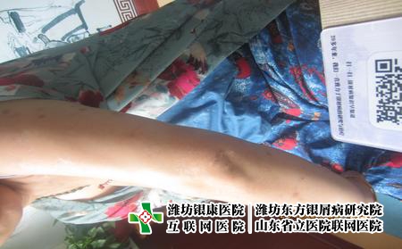 濰坊那治牛皮癬好，濰坊東方怎么治牛皮癬
