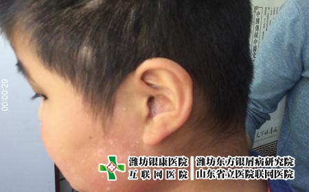 濰坊看兒童牛皮癬的好醫院，兒童牛皮癬怎么辦