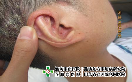 濰坊兒童牛皮癬是怎么引起，為什么會得牛皮癬