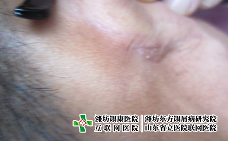 濰坊牛皮癬老不好很痛苦怎么辦,頑固牛皮癬怎么治 濰坊牛皮癬老不好很痛苦怎么辦,頑固牛皮癬怎么治