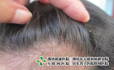 濰坊牛皮癬怎么檢查，如何確定是不是牛皮癬