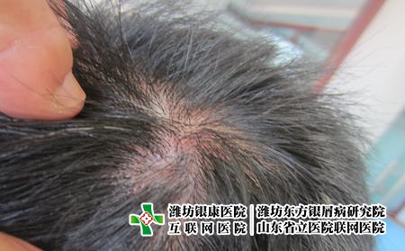 濰坊牛皮癬的發病原因,為什么老得牛皮癬 濰坊牛皮癬的發病原因,為什么老得牛皮癬