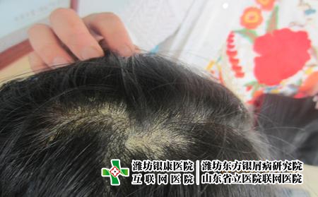 濰坊什么因素誘發的牛皮癬,牛皮癬怎么得上的 濰坊什么因素誘發的牛皮癬,牛皮癬怎么得上的