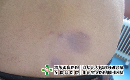 得了牛皮癬各方面注意事項(xiàng)，牛皮癬的治療和調(diào)理