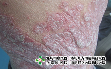 在濰坊應該怎么治療牛皮癬這種病，牛皮癬怎么治才能好