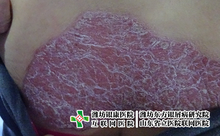 牛皮癬會引發(fā)的心理問題嗎，牛皮癬對心理的影響怎么解決