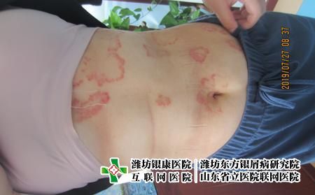 妊娠對牛皮癬有影響嗎，懷孕會(huì)導(dǎo)致牛皮癬發(fā)作嗎