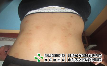 牛皮癬不同時期怎么治，濰坊東方怎么治牛皮癬