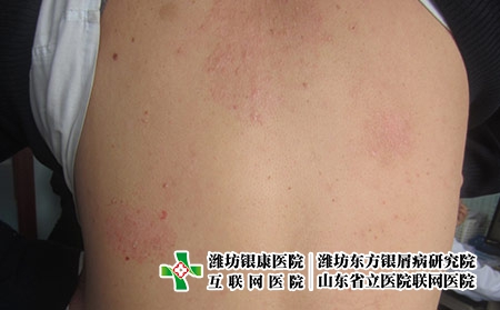 血熱型牛皮癬是怎么回事，牛皮癬怎么治