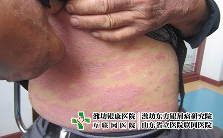 在濰坊治療牛皮癬的價格貴嗎，治療牛皮癬花錢多不多