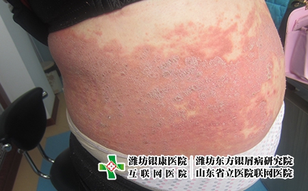 濰坊治療牛皮癬的醫院哪家正規，濰坊東方好不好
