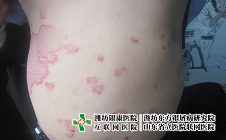 如何保護皮膚減少牛皮癬的發(fā)生，怎么避免牛皮癬的復發(fā)