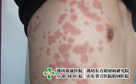 得了牛皮癬怎么面對，怎么做讓牛皮癬好的快