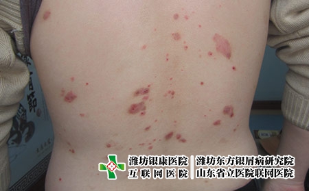 男性牛皮癬怎么治療恢復快，牛皮癬比較好的治療辦法