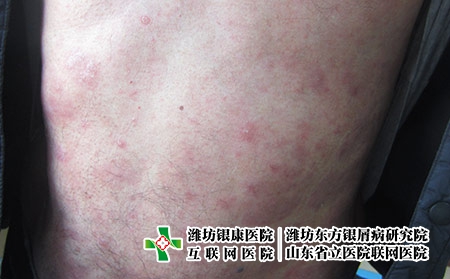 濰坊市看牛皮癬醫院哪個比較好,濰坊東方專業專注 濰坊市看牛皮癬醫院哪個比較好,濰坊東方專業專注