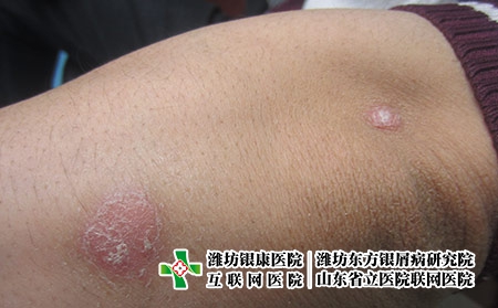 看牛皮癬費(fèi)用要多少，治牛皮癬貴不貴