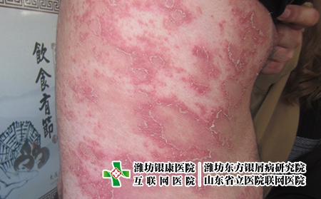 牛皮癬類型有哪些，牛皮癬有很多種嗎