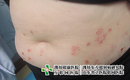 牛皮癬什么時候治療效果好,牛皮癬治療拖不得 牛皮癬什么時候治療效果好,牛皮癬治療拖不得