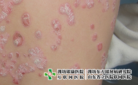 牛皮癬應怎樣醫(yī)治，牛皮癬老反復不好治怎么辦