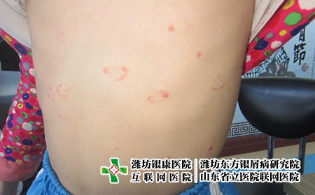 治療牛皮癬哪家醫院，濰坊東方專業