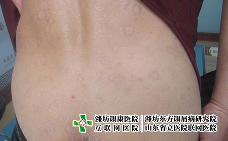 牛皮癬到底什么方法能治好，怎么才是正確治療牛皮癬