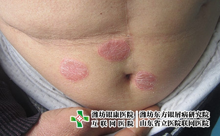 皮膚上出現的癬會是牛皮癬么，牛皮癬剛開始什么樣