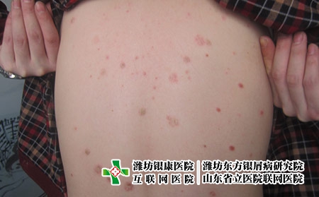 紫外線治療牛皮癬怎么樣，光療能治牛皮癬嗎