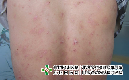 牛皮癬患者應該吃什么好，牛皮癬適合吃什么水果