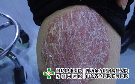 濰坊專業的牛皮癬醫院，濰坊東方怎么治牛皮癬